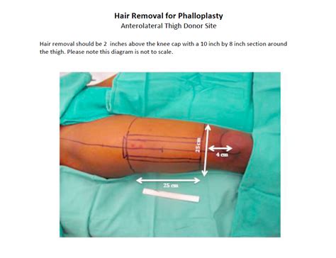 faloplastia|Phalloplasty Gender Confirmation Surgery